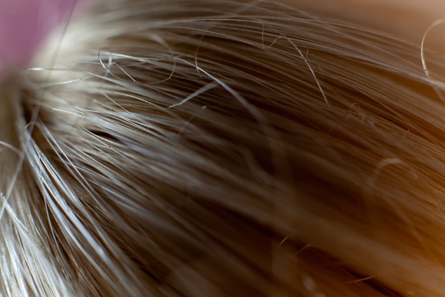hair transplant recovery